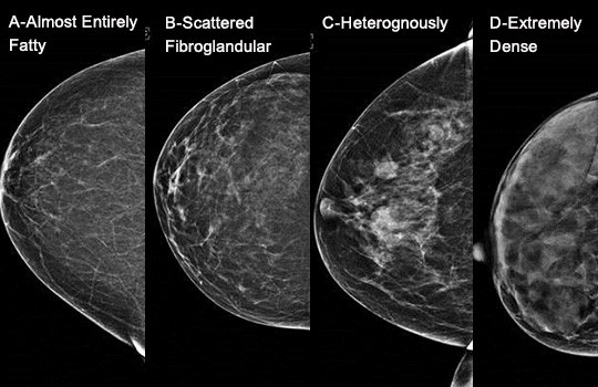 Understanding Breast Density  Western Missouri Medical Center